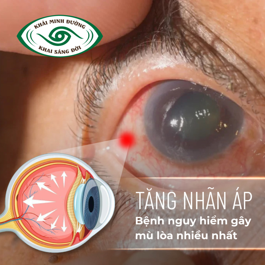 Benh Tang Nhan Ap Nguy Hiem