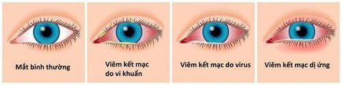Nguyen Nhan Viem Ket Mac