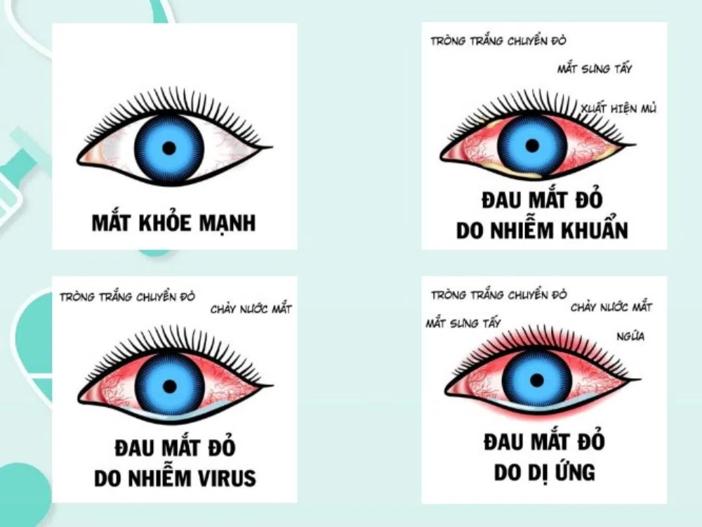 Nhan Biet Viem Ket Mac
