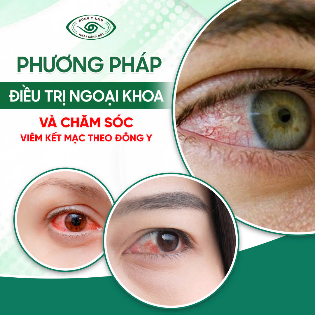 Phuong Phap Dieu Tri Ngoai Khoa va cham soc viem ket mac theo dong y